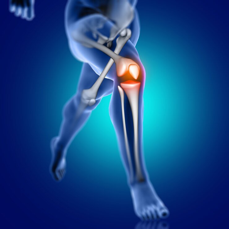 Knee Osteoarthritis