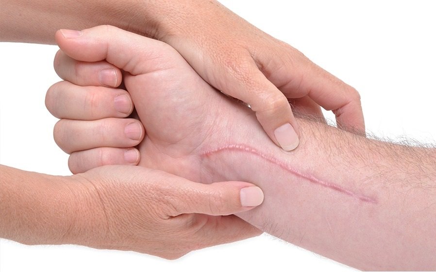 Scar Pain