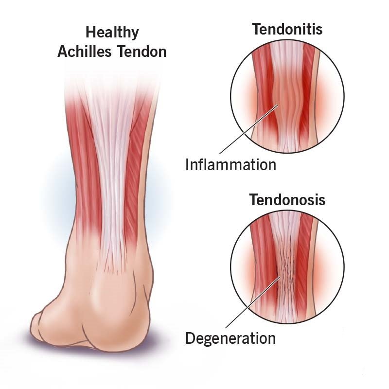 Tendonitis And Muscle Tear