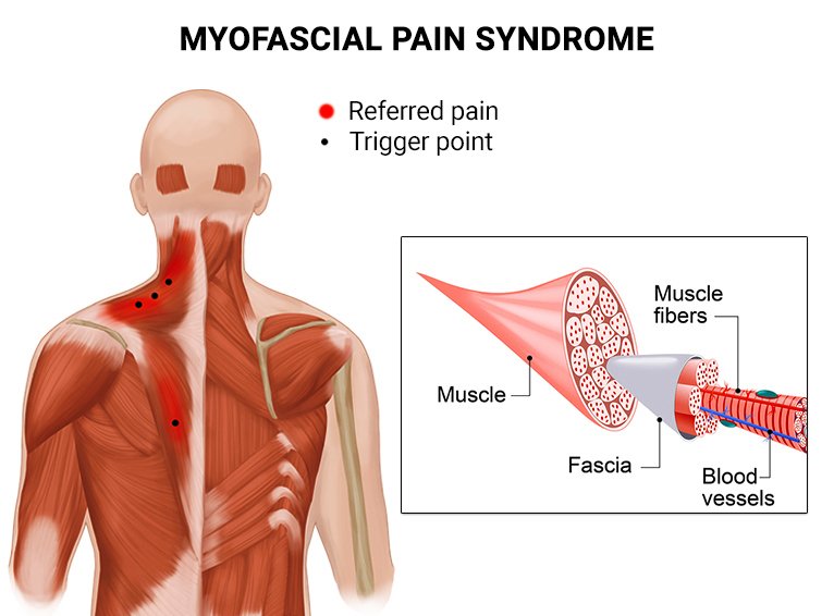 Myofascial Pain Treatment in Rohini