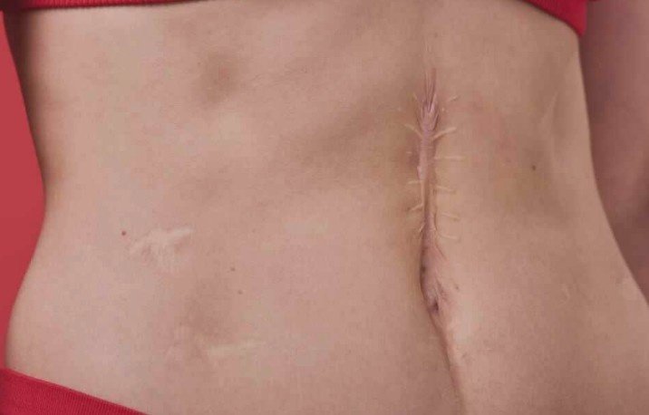 Post-Scar Neuralgia Treatment in Rohini