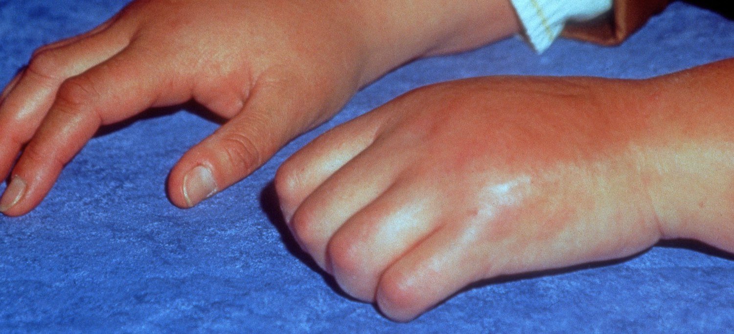 Complex Regional Pain Syndrome