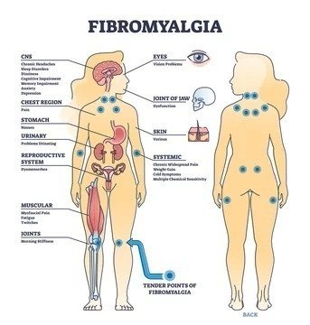 Fibromyalgia