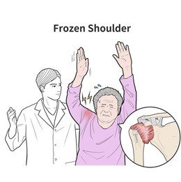 frozen shoulder