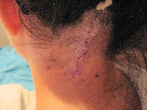 Post Scar Neuralgia Treatment in Rohini