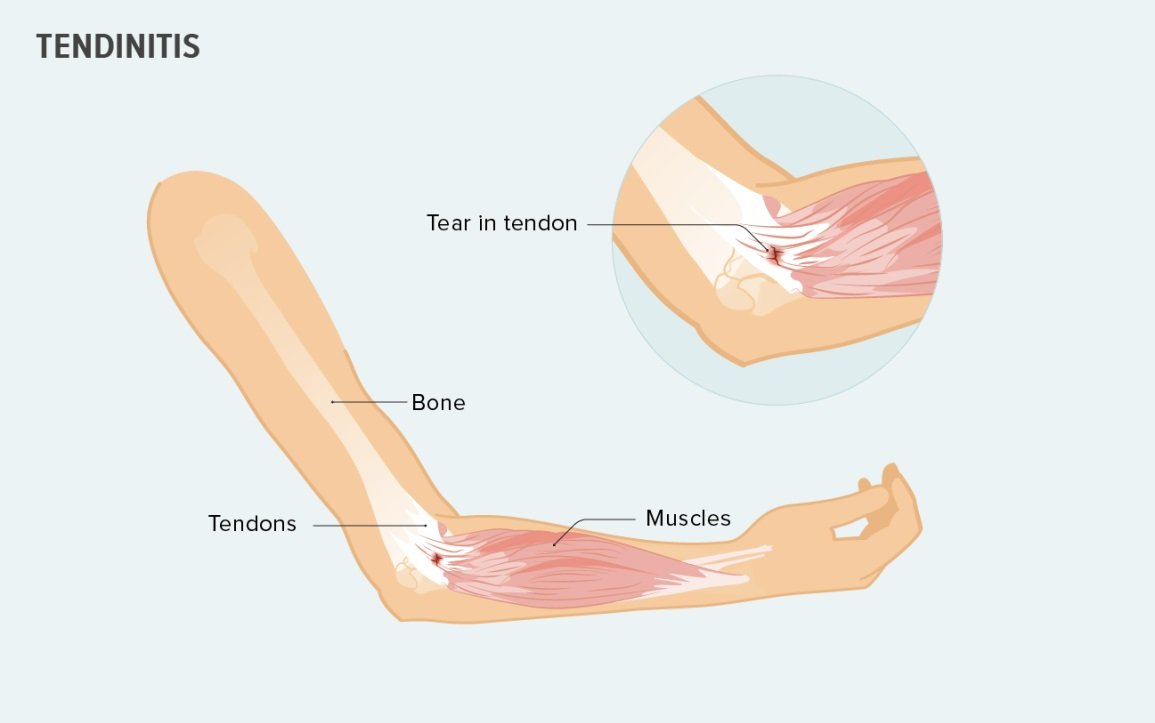Tendonitis and Muscle Tear Treatment in Rohini