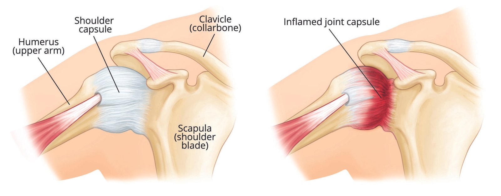 Frozen shoulder Treatment in Delhi