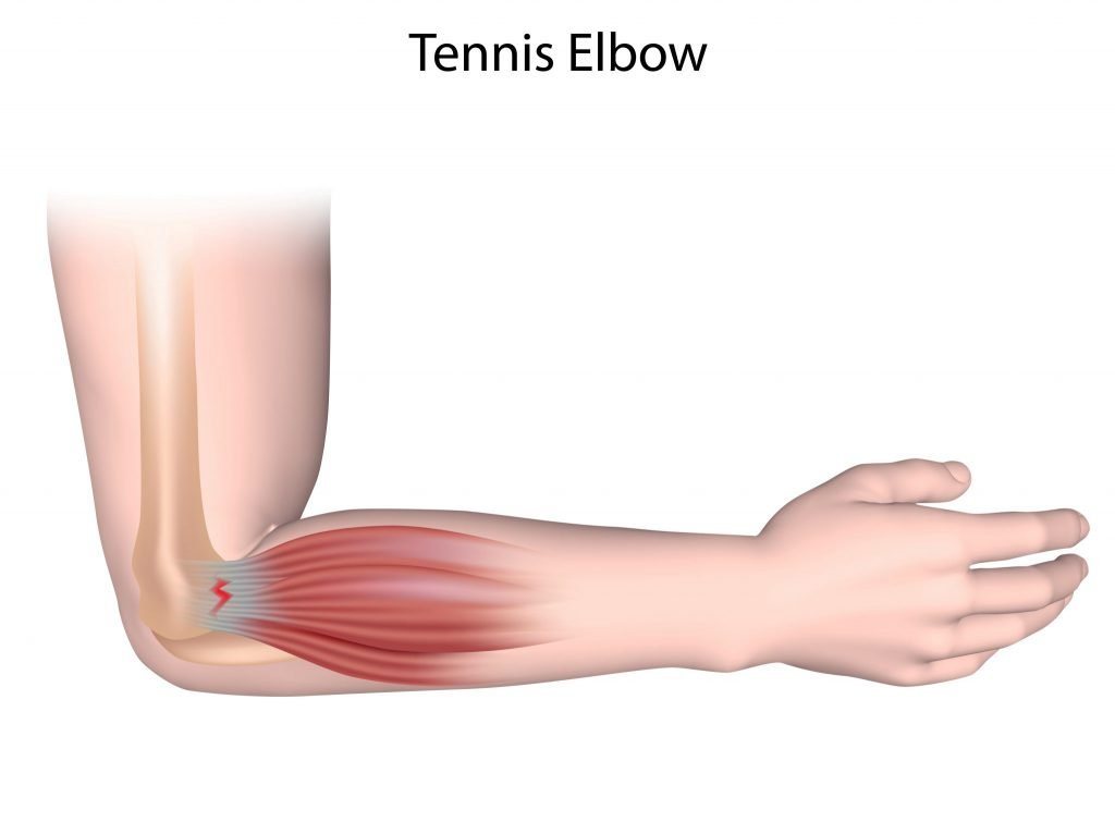 Tennis Elbow Treatment in Rohini