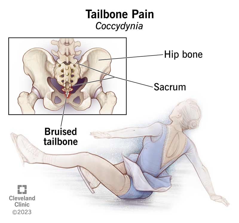 Tailbone Pain Treatment in Delhi