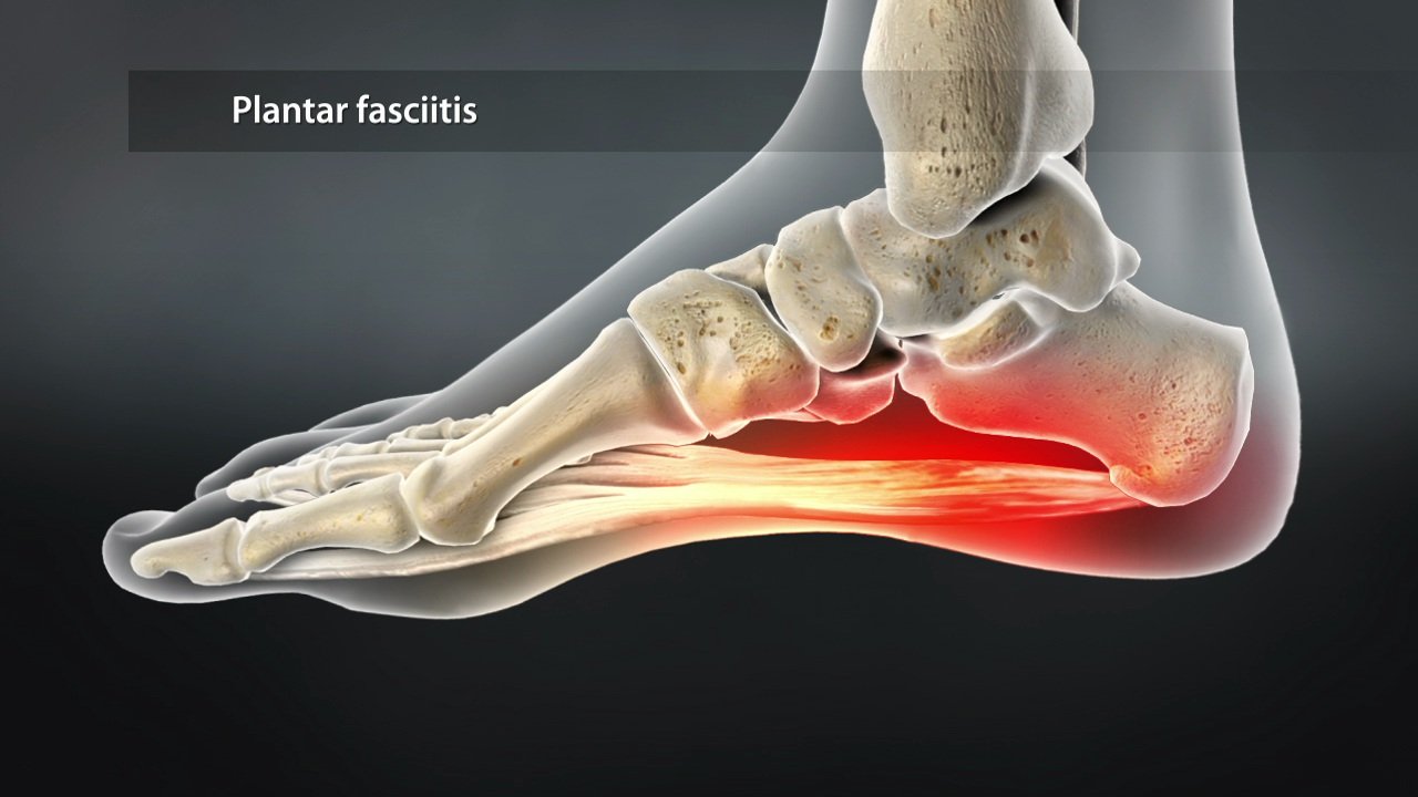 Best Plantar Fasciitis Treatment in Sector 7, Delhi