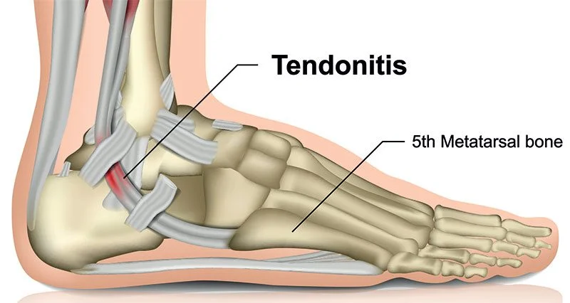 Best Tendonitis Treatment near me