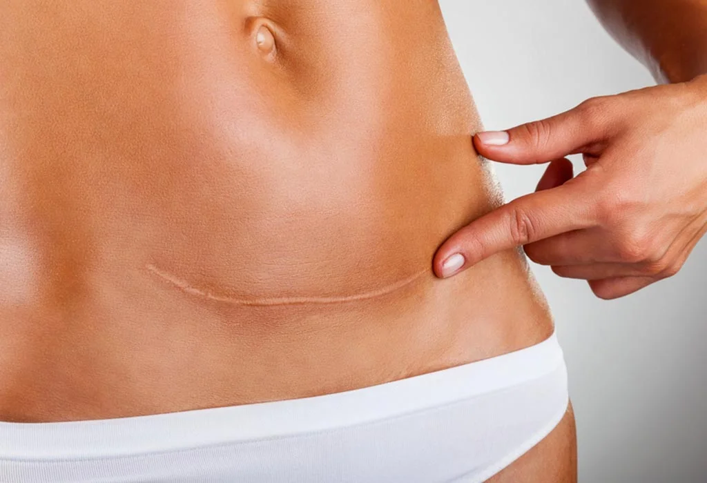 Best Post Scar Neuralgia Treatment in North Delhi