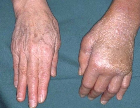 Best CRPS Pain Relief Treatment in Delhi