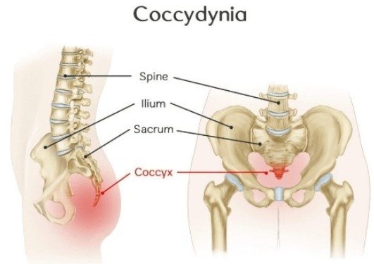 Tailbone Pain Treatment Clinic in Delhi